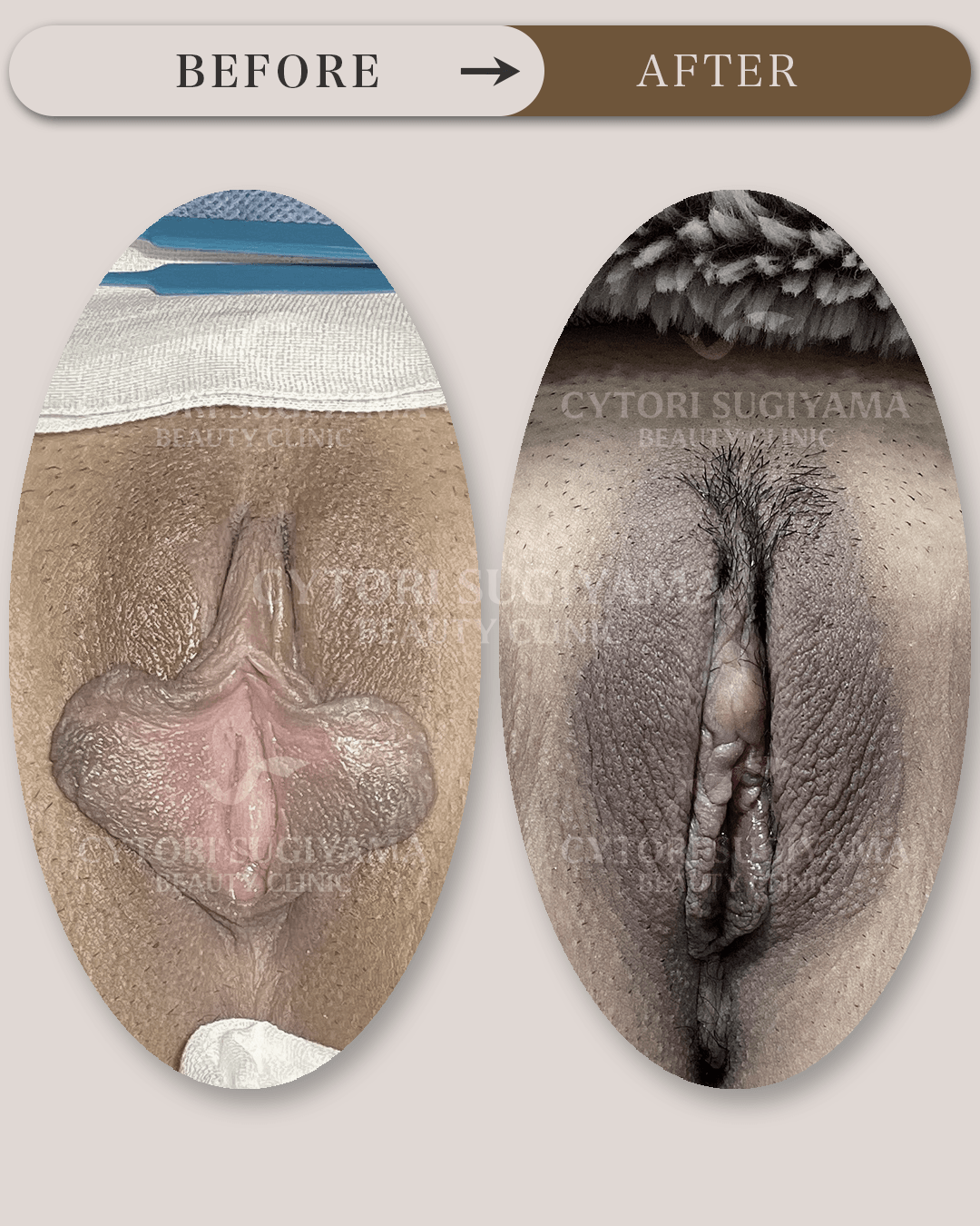 小陰唇縮小術と副皮切除術を受けられる前後の画像