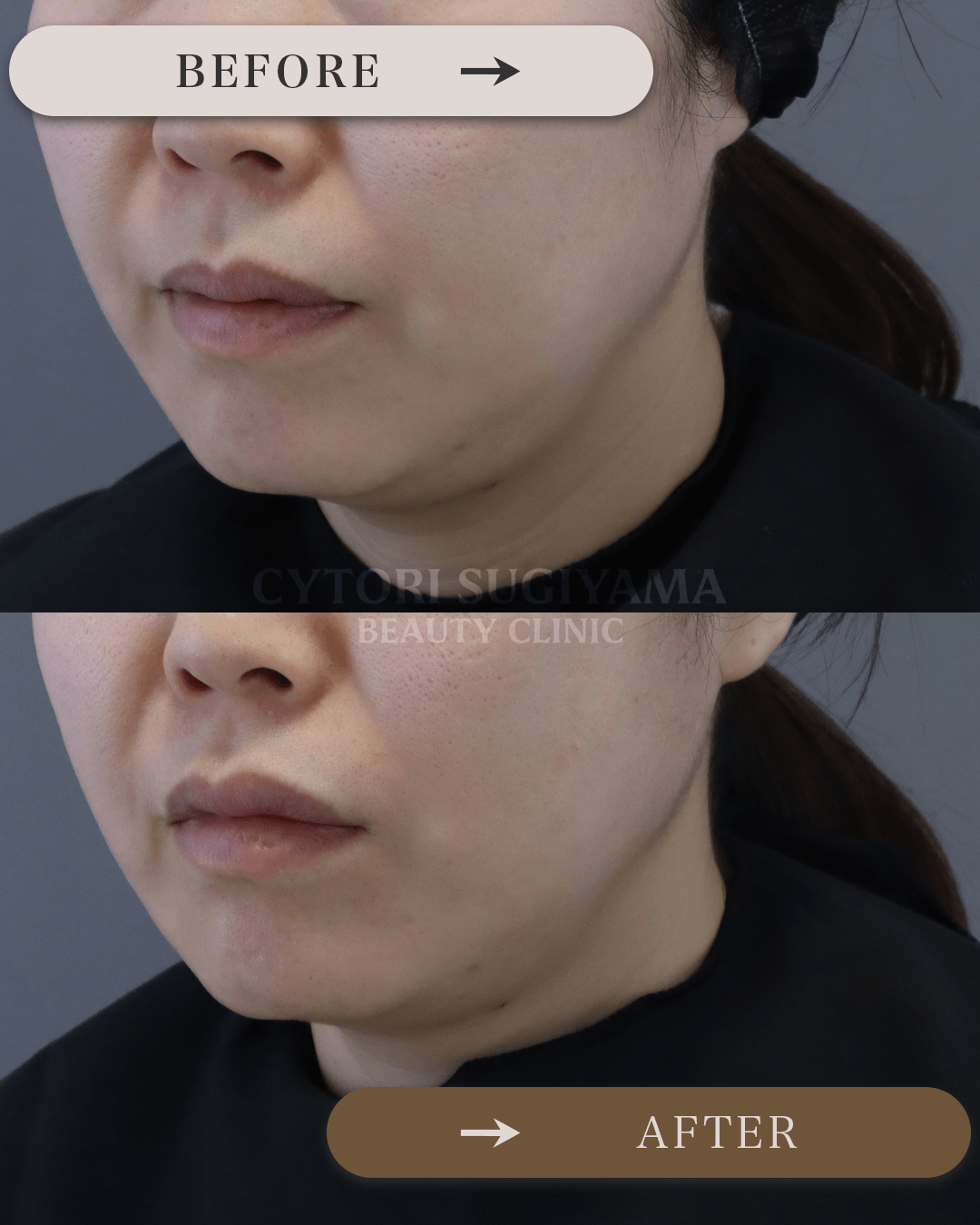 糸リフトを受けられる前後の画像