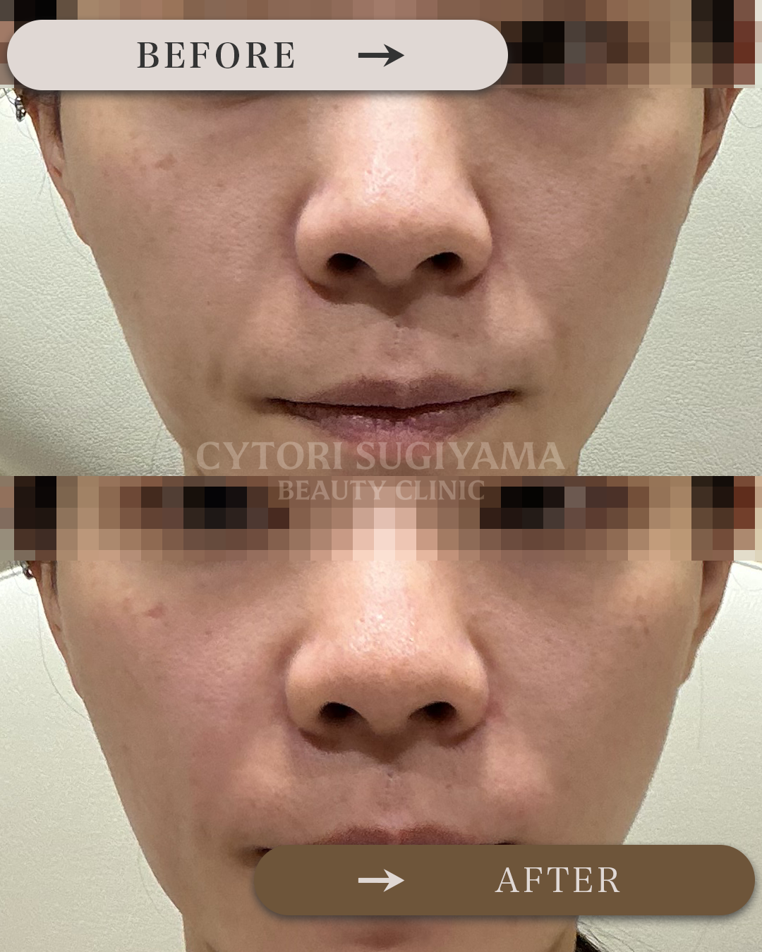 ヒアルロン酸注入を受けられる前後の画像