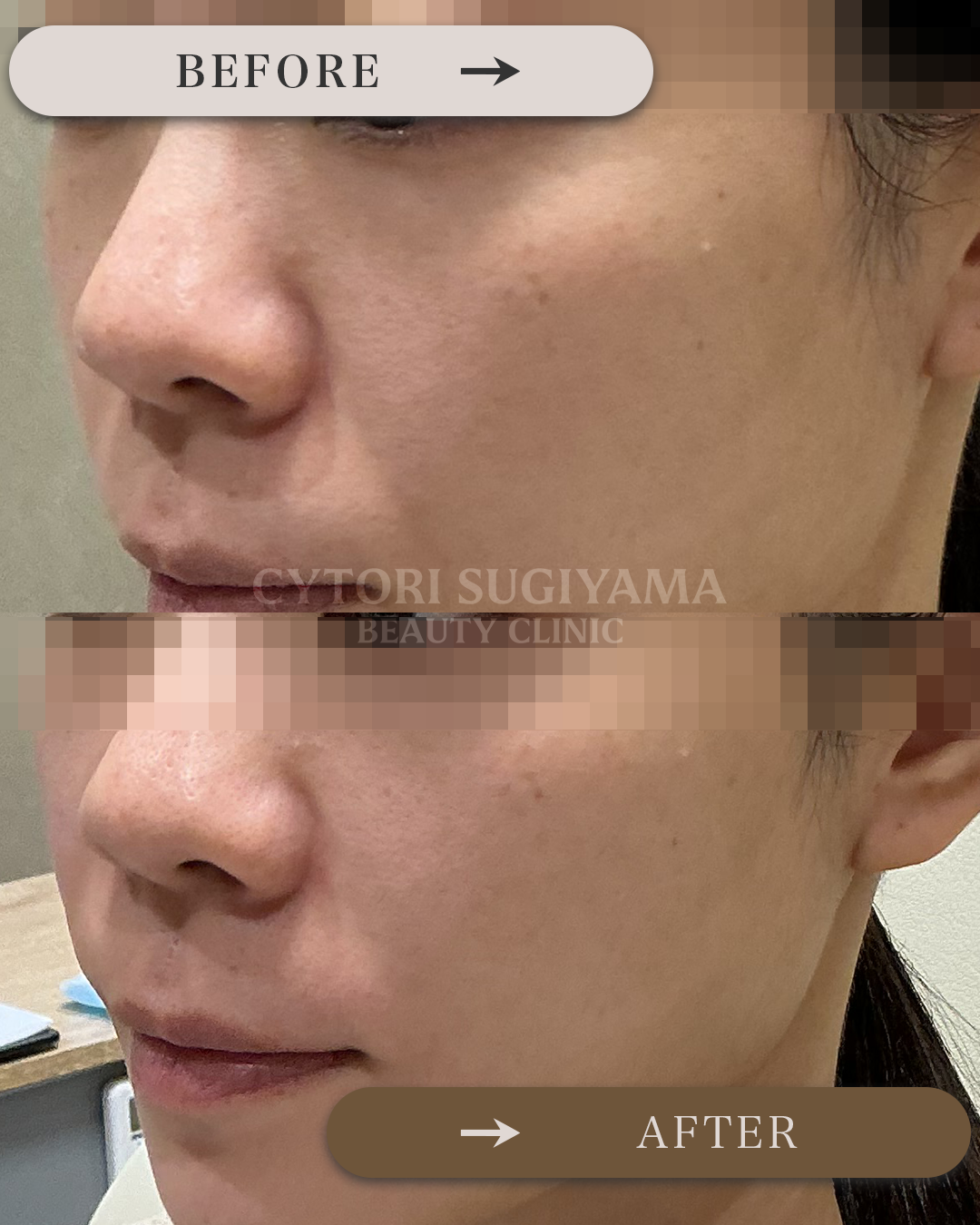 ヒアルロン酸注入を受けられる前後の画像